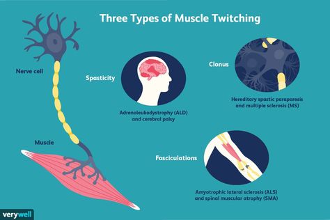 Types Of Muscles, Spinal Muscular Atrophy, Ms Symptoms, Muscle Twitching, Motor Neuron, Liver Failure, Nerve Cell, Muscle Up, Muscle Spasms