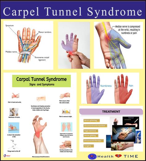 How To Wrap Your Wrist For Carpal Tunnel, Carpel Tunnel Symptoms, Carple Tunnel, Carpal Tunnel Remedies, Carpel Tunnel Syndrome, Hand Therapy Exercises, Carpal Tunnel Exercises, Nerve Pain Remedies, Carpel Tunnel