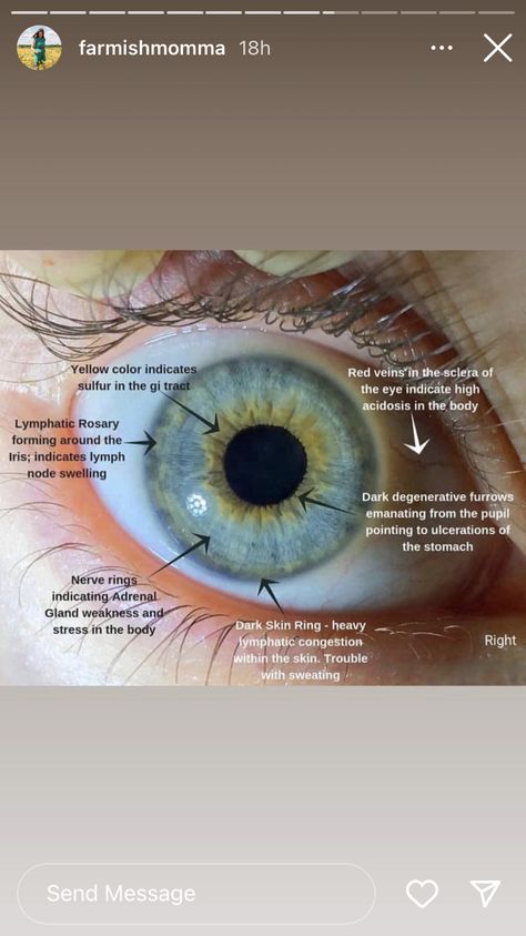 Iridology Chart Eye, Opthalmic Technician, Iridology Chart, Dr Morse, Optometry Education, Eye Facts, Reflexology Chart, Nursing School Studying, Eye Prescription