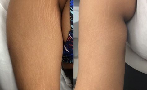 Laser stretch mark removal – before and after | Pulse Light Clinic London Laser Stretch Mark Removal, Stretch Mark Oil, Abdominal Stretches, Oils For Scars, Laser Removal, Skin Bumps, Best Lotion, Stretch Mark Cream, Stretch Mark Removal