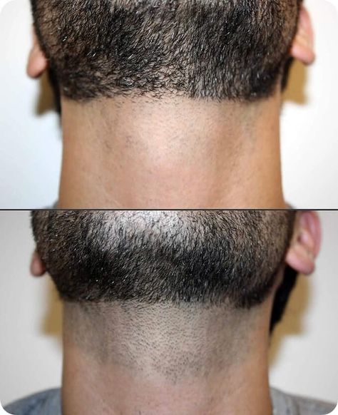 Trim Beard Neckline, Laser Hair Removal Men, Laser Hair Removal Face, Beard Neckline, Hair Remove, Laser Removal, Skin Care Business, Hair Removal For Men, Cosmetic Dermatology