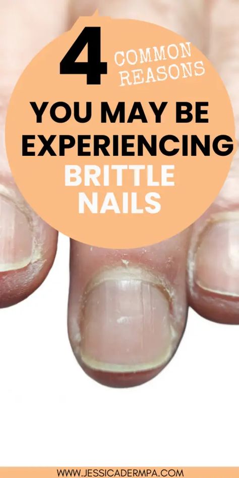 If your nails are breaking easily and you don't know why then read more to learn about potential causes and skin care solutions to strengthen your nails. Brittle Nails Causes, Nail Bed Damage, Bumpy Nails, Dermatology Physician Assistant, Nail Disorders, Strengthen Nails, Butterfly Nail Designs, Nail Infection, Gel Acrylic Nails