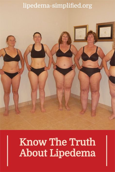 Know The Truth About Lipedema Heavy Lower Body Outfits, Fat Legs Before And After, Lipodemia Diet, Lipedema Diet Plan, Fat Knees How To Get Rid Of, Lipedema Exercise, Fat Leg Workout, Lipedema Before And After, Heavy Lower Lip