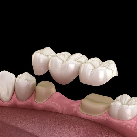 If you’ve lost a tooth, but aren’t ready to commit to a dental implant, then a dental bridge is your next best option. Dental bridges are a series of dental crowns that span the gap left after a tooth is lost or extracted. Your dental bridge will be made from high-quality materials and color-matched to look natural alongside your existing teeth.   Call us ☎️ 727-513-8283 #NuSmileDental #DentalBridge #RestorativeDentistry #MissingTeeth Crown And Bridge Dental Teeth, Dental Implants Advertising, Dental Bridge Front Teeth, Dental Amalgam, Prosthetic Device, Tooth Filling, Missing Teeth, Dental Fillings, Restorative Dentistry