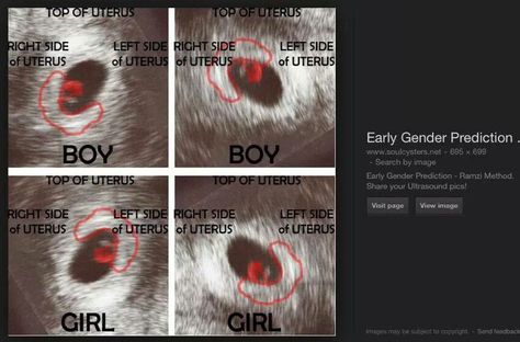 early gender prediction - boy if transvaginal, girl if abdominal (Ramzi theory) Boy Or Girl Prediction Signs, 7 Weeks Pregnant Ultrasound, Ultrasound Gender Prediction, Boy Or Girl Prediction, Early Gender Prediction, Ramzi Theory, Endoscopy Procedure, Ultrasound Gender, Easter Baby Photos