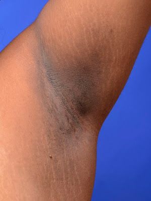 Reason for dark underarms, dark underarm Underarm Darkness, For Dark Underarms, Smelly Underarms, Wax Man, Underarm Odor, Dark Armpits, Shoot Moodboard, Underarm Hair Removal, Dark Underarms