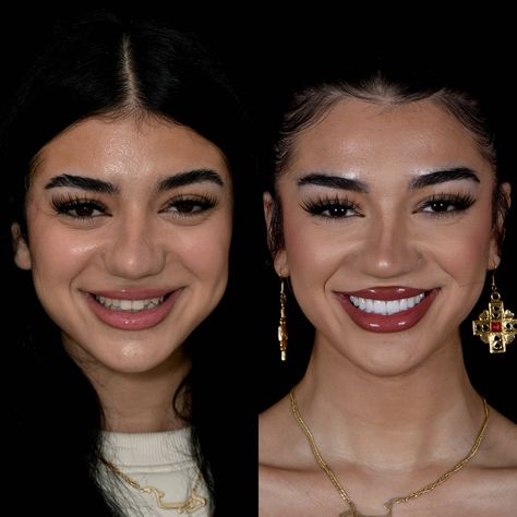 Veneers Before And After, Lumineers Teeth, Cosmetic Bonding, Cosmetic Dentistry Veneers, Botox Before And After, Hollywood Smile, Laser Dentistry, Bone Grafting, Veneers Teeth