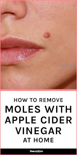 How To Remove Moles, Remove Moles, Skin Moles, Skin Growths, Mole Removal, Weight Changes, Natural Sleep Remedies, Natural Cold Remedies, Natural Cough Remedies