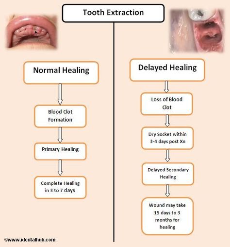 Wisdom Teeth Food, Tooth Extraction Aftercare, Tooth Extraction Healing, Dental Assistant Study, Tooth Removal, Wisdom Teeth Removal, Emergency Dentist, Tooth Extraction, Dental Life