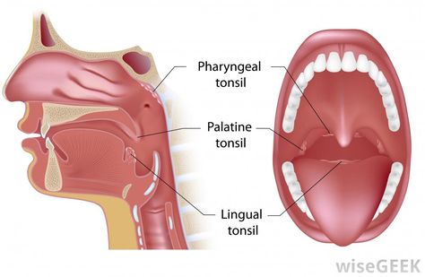 Pharyngeal tonsils (adenoids)  palatine tonsils (tonsillectomy) Lingual Tonsils, Swollen Tonsils, Tonsils And Adenoids, Strep Throat, Respiratory System, Anatomy And Physiology, Home Remedies, Anatomy, Disease