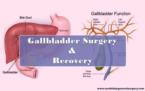 Gallbladder Removal Recovery, Post Gallbladder Surgery Diet, Gallbladder Surgery Diet, Gallbladder Removal Diet, After Gallbladder Removal, After Gallbladder Surgery, Gallbladder Removal, Gallbladder Diet, Gallbladder Surgery