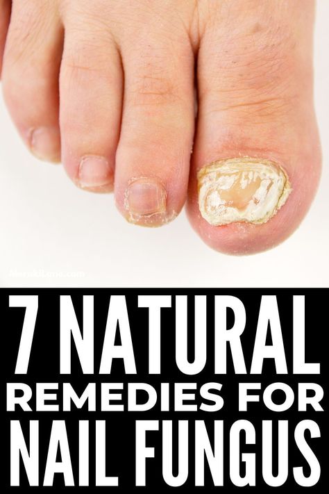 7 Home Remedies for Nail Fungus That Work | Nail fungus is common but unpleasant. It can appear on your fingernails and toenails, causing discoloration, cracks, and brittle nails. Thankfully, it can be cured, and we're curated the best homemade natural remedies to get rid of toenail fungus fast. Click to find out how you can get rid of a toenail fungal infection ASAP using ingredients you probably already have on hand, like apple cider vinegar, essential oils, black tea, and more! Fungal Infection Remedies, Toenail Fungal Infection, Nail Remedies, Fingernail Fungus, Nail Fungus Remedy, Nail Infection, Fungal Nail, Work Nails, Striped Nails