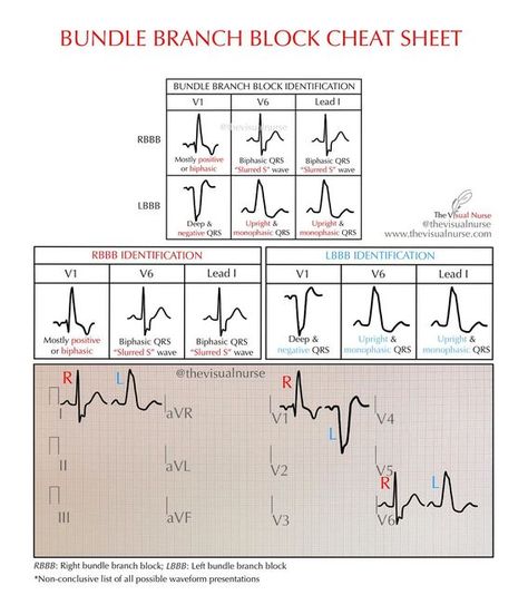 Tyler | The Visual Nurse on Instagram: "Right and left bundle branch block identification cheat sheet. . . Feel free to bookmark and save 👍🏼 . . Follow @thevisualnurse on Instagram for daily rhythm quizzes! . . . #cardiology #cardiacnurse #ekg #futurenurse #nursing #nursingschool #nursingstudent #nursepractitioner #NCLEX #paramedicstudent #RN #FOAMED #residency #exercisescience #nursingeducation #nurseeducator =================== 📱: Instagram @thevisualnurse ⏱: TikTok @the.visualnurse 💻: www Cardiac Pharmacology, Left Bundle Branch Block, Medic School, Emt Study, Paramedic Student, Bundle Branch Block, Ekg Interpretation, Paramedic School, Daily Rhythm