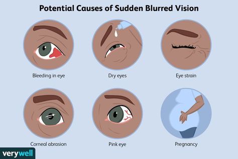 What’s Causing My Sudden Blurry Vision? Eye Supplements, Dry Eye Symptoms, Eye Pain, Headache Types, Blurry Vision, Desktop Background Pictures, Eye Exercises, Blood Pressure Medications, Vision Loss