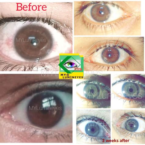 Change your eye color from brown to green or blue naturally by Lumineyes laser eye color change surgery. #lumineyes #lasereyecolorchange #lumineyesxtra #drmustafamete #eyecolorchangelaser #blueeyes #mylumineyes #eyecolorchangesurgery https://mylumineyes.com/ Green Eyes Subliminal Result, Iridology Reading, Eye Color Change Surgery, Woman Eyes, Change Your Eye Color, Heart Diet, Laser Eye, Blue Eye, Plastic Surgery