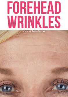 Forehead Wrinkles Remedies, Get Rid Of Forehead Wrinkles, Wrinkle Remedies, Anti Aging Creme, Forehead Wrinkles, Face Wrinkles, Wrinkled Skin, Prevent Wrinkles, Sagging Skin