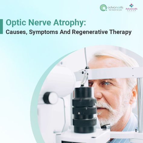 Optic nerve atrophy is a condition in which the optic nerve gets damaged and the type of atrophy depends on the cause. Optic nerve atrophy starts with a blur and leads to a gradual loss of vision, as the light that strikes the retina is not processed in the brain since the optic nerve fails to transmit signals properly. #MacularDegeneration #EyeDisease #opticatrophytreatment #opticatrophytreatmentinindia #opticnerveatrophy #opticnerveatrophytreatment #opticatrophycauses Optic Nerve Damage, Optic Nerve, Nerve Damage, Eye Health, The Brain, Nerve, Blur, Fails, Disease