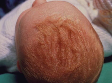 cradlecapphoto_sized Baby Losing Hair, Baby Dry Scalp, Crusty Skin, Cradle Cap, Lost Hair, Baby Center, Dry Scalp, Red Dots, Skin Conditions