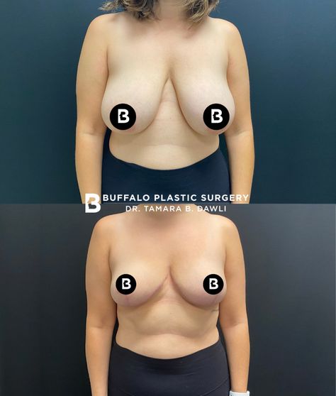 Breast Reduction Aesthetic, Mastopexy Before And After, Breast Surgery Before And After, Breast Lift Before And After, Breast Lift Surgery Before And After, Breast Reduction Before And After, Breast Reduction Recovery, Body Lift Surgery, Plastic Surgery Pictures