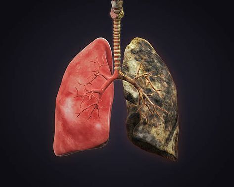 Smokers Lungs, Healthy Lungs, Types Of Cancers, Chest Pain, Homeopathy, Lungs, Power Point, Respiratory, Health Problems