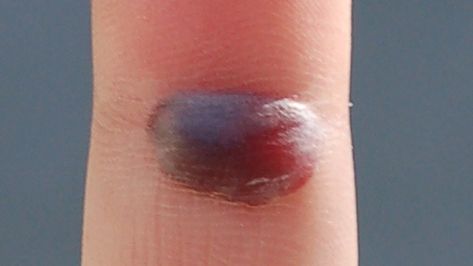 Blood Blister: Symptoms, Causes, Diagnosis Blood Blister, Layers Of Skin, Blood Vessels, New Skin, Skin Protection, Red