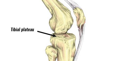 Physical Therapy for Tibial Plateau Fracture Recovery - Park Sports Physical Therapy - Brooklyn, NY Tibial Plateau Fracture, Knee Meniscus, Physiotherapy Exercises, Gait Training, Jumpers Knee, Sports Physical Therapy, Knee Ligaments, Kinesiology Taping, Knee Pain Relief