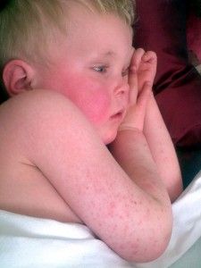 Rash On Hands, Common Skin Rashes, Fever Symptoms, Children Pictures, Skin Rashes, Heat Rash, Dry Skin Remedies, Lotion For Dry Skin, Viral Infection