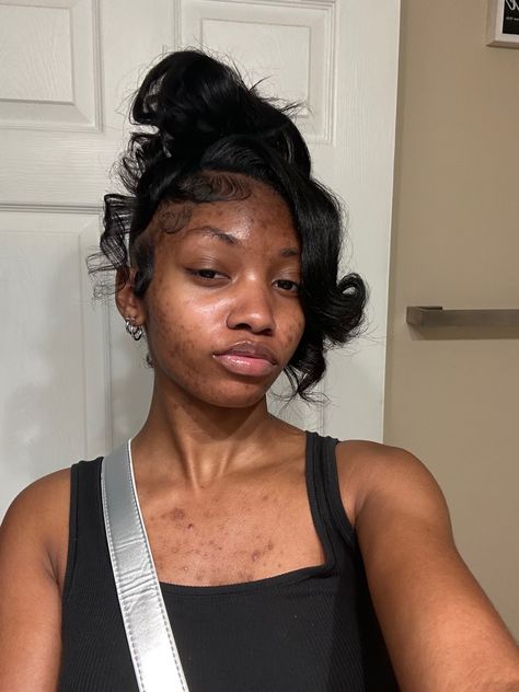 Bare Face Black Women, Natural Face Black Women, Acne Aesthetic Girl, Bad Acne Pictures, Pretty People With Acne, Acne Pretty, Acne Aesthetic, Acne Awareness, Beautiful Acne