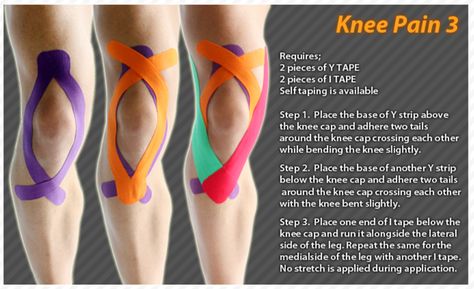 Kinesiology taping instructions for knee pain #ktape #knee #pain #ares Knee Taping, Knee Pain Relief Exercises, K Tape, Kt Tape, Knee Pain Exercises, Kinesio Taping, Kinesiology Taping, Knee Exercises, Planet Fitness