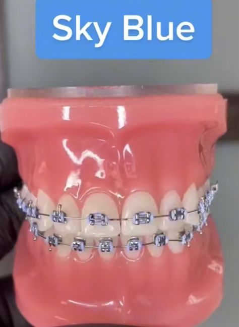 Braces Ideas Cute, Braces Sky Blue, Periwinkle Braces, Light Purple Braces, Lilac Braces, Sky Blue Braces, Lavender Braces, Navy Blue Braces, Light Blue Braces