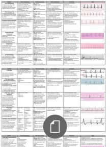 ECG Interpretation Cheat Sheet Ekg Nursing, Sinus Massage, Ekg Rhythms, Nurse Brain Sheet, Ekg Interpretation, Nursing Cheat Sheet, Ecg Interpretation, Cardiac Rhythms, Nursing Cheat