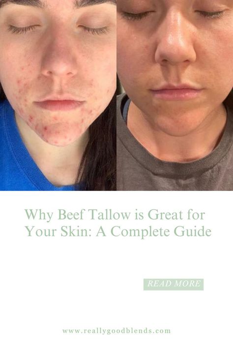 https://reallygoodblends.com/blogs/the-tallow-huddle/is-beef-tallow-good-for-skin Benefits Of Beef Tallow, Skin Care Guide, Beef Tallow, Natural Moisturizer, Holistic Living, Skin Benefits, Essential Nutrients, Organic Beauty, Radiant Skin