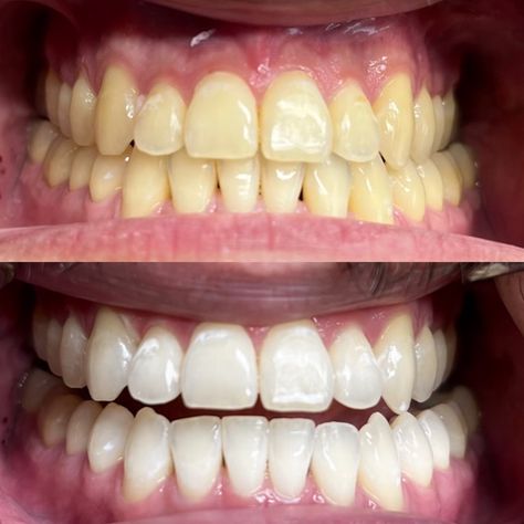 Teeth Whitner, Teeth Whitening Professional, Teeth Problems, Laser Whitening, Teeth Whitening Dentist, Cosmetic Dentistry Procedures, Teeth Whitening Procedure, Dental Decay, Brighten Teeth