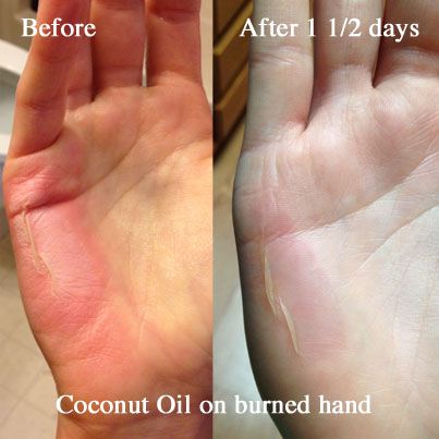 Coconut Oil for Burns: Real Me Monday Treating Burns Remedies, Home Remedy For Burns Hands, Burn Remedies Hand, How To Treat A Burn Skin, Burn Relief Hand, What To Put On Burns On Skin, Burn On Hand, Hand Burns Skin, Coconut Oil For Burns