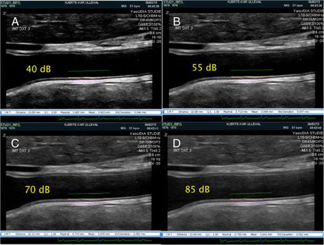 Carotid intima media thickness (CIMT) measured with ultrasound (US) is widely used as biomarker for arteriosclerosis and as surrogate endpoint in interventional studies to assess efficacy of drug therapies. Strict US protocols are necessary to ensure reproducibility. The range of US signal intensities used for image formation, the dynamic range (DR), is rarely reported in studies and little is known about its effect on CIMT measurements in humans. The purpose of this study was to quantify the... Carotid Artery, Standard Deviation, Ultrasound, 7 And 7, Assessment, Career, Range, Media