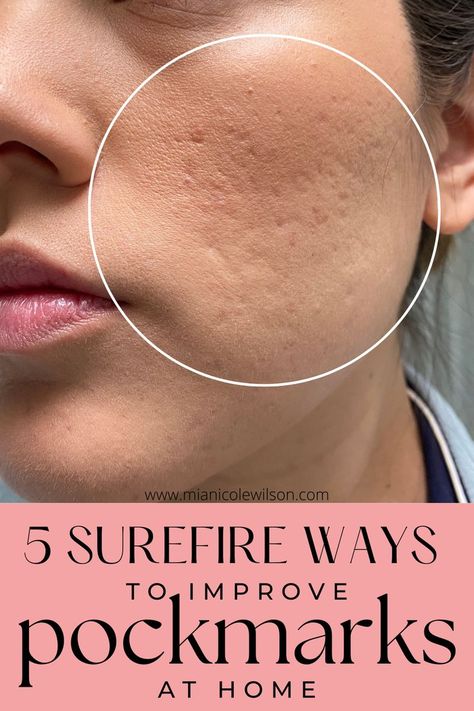 guide to get smooth clear skin Acne Pit Scars, Anti Acne Skin Care, Skin Treatments For Acne, Face Map, Back Acne Remedies, Treatments For Acne, Scar Remedies, Face Mapping Acne, Forehead Acne