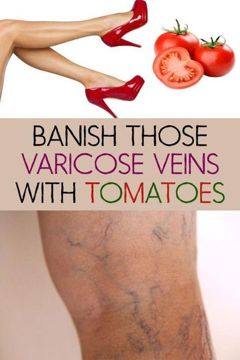 NATURAL WAYS TO GET RID OF SPIDER VEINS ? How to Get Rid of Varicose Veins: 5 Natural Remedies Varicose Vein Remedy, Get Rid Of Spiders, Vein Removal, Natural Healing Remedies, Skin Remedies, Natural Health Remedies, Natural Food, Feel Better, Home Remedies