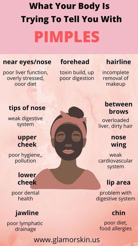 What Your Pimples Are Telling You, Pimple Prevention Tips, How To Remove Acne And Pimples, To Get Rid Of Pimples, How To Not Get Pimples, How Do You Get Rid Of A Pimple Overnight, Tips To Prevent Acne, How To Remove A Pimple Overnight, How To Get Rid Of Pimples Under The Skin