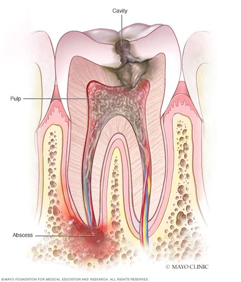 Tooth abscess - Symptoms and causes - Mayo Clinic Tooth Abcess Remedy, Abscess Tooth, Tooth Pain Remedies, Wisdom Teeth Pain, Teeth Images, Teeth Remedies, Dental Images, Tooth Infection, Dental Posters