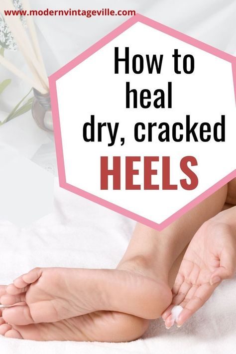 Chemical Peel At Home, Dry Cracked Heels, Heel Care, Dry Heels, Natural Remedies For Migraines, Best Lotion, Dry Skin Remedies, Homemade Hair Products, Young Skin