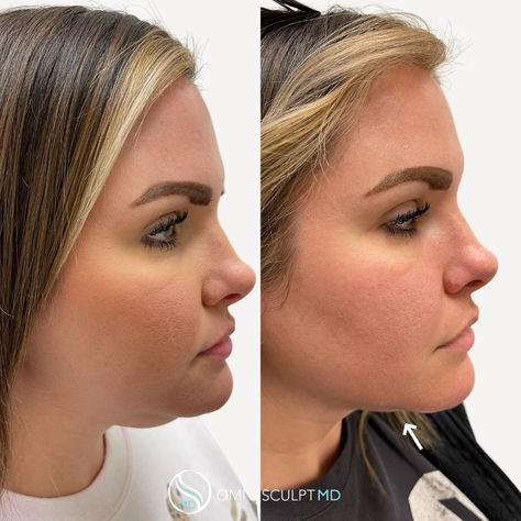 View Our Kybella Before & After Gallery | OMNI SCULPT MD Double Chin Before And After, Kybella Before And After Double Chin, Chin Lipo Before And After, Kybella Before And After, Lipo Before And After, Double Chin, Cosmetology, Round Face, Dallas Tx