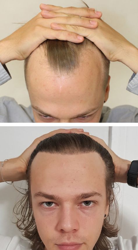 Top Quality Hair Transplant Hair Transplant Before And After Men, Hair Transplant Before And After, Hair Problems Solutions, Eyebrows Tattoo, Hair Implants, Hair Transplant Results, Scalp Micropigmentation, Whiter Teeth, Barbershop Design