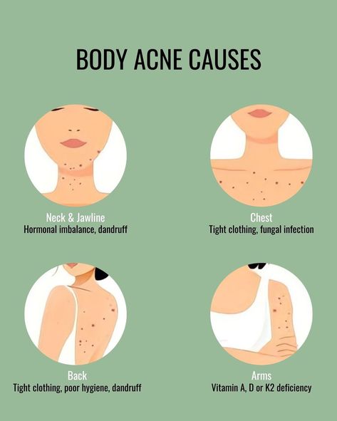 Struggling with body acne? 😓 You’re not alone! From sweat and friction to clogged pores and hormonal changes, there are several factors that can trigger those pesky breakouts. Understanding the cause is the first step to clear, healthy skin. 🌟 Let’s break down the common culprits and how to combat them! #BodyAcne #SkinCareTips #clearskinjourney Acne Chart, Teen Skincare, How To Reduce Pimples, Clear Healthy Skin, Night Time Skin Care Routine, Acne Causes, Body Acne, Sensitive Skin Care, Hormonal Changes