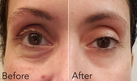 The Peptide-Packed Fermentation Eye Cream That Made One Woman's Eyes Look More Youthful and Less Tired in Two Weeks (Before & After Photos) Glow Fairy, Micro Needling, Dark Circles Under Eyes, Eye Wrinkle, Derma Roller, Under Eye Bags, Tired Eyes, Eye Serum, Brightening Serum