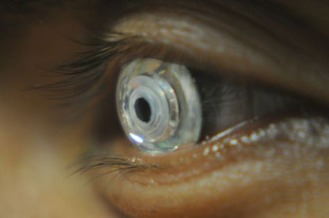 Telescopic Contact Lens Could Improve Eyesight for the Visually Impaired Google Glass, Eye Sight Improvement, Future Tech, Wearable Tech, Medical Technology, Contact Lens, Cool Tech, Electrical Engineering, Black Mirror