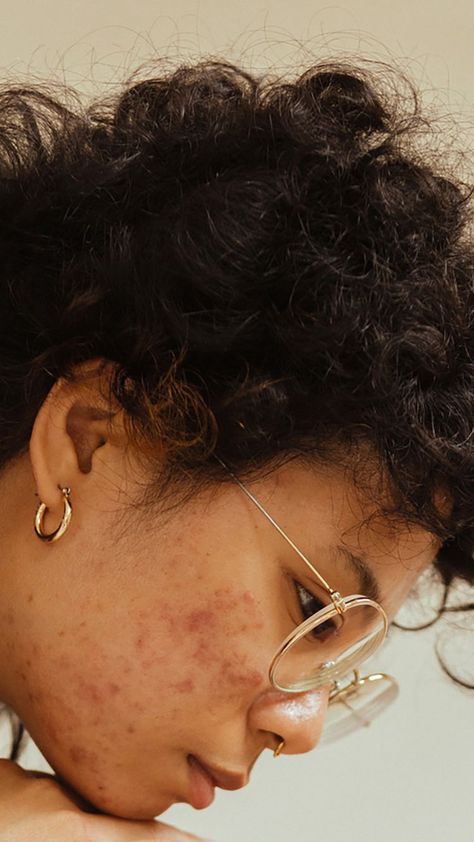 At What Age Does Acne Go Away? We Asked Dermatologists