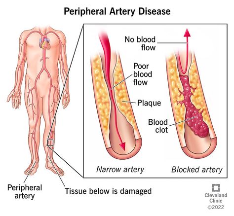 Peripheral Artery, Guillain Barre Syndrome, Disease Symptoms, Coronary Arteries, Cleveland Clinic, Leg Pain, Health Articles, Autoimmune Disease, Lifestyle Changes