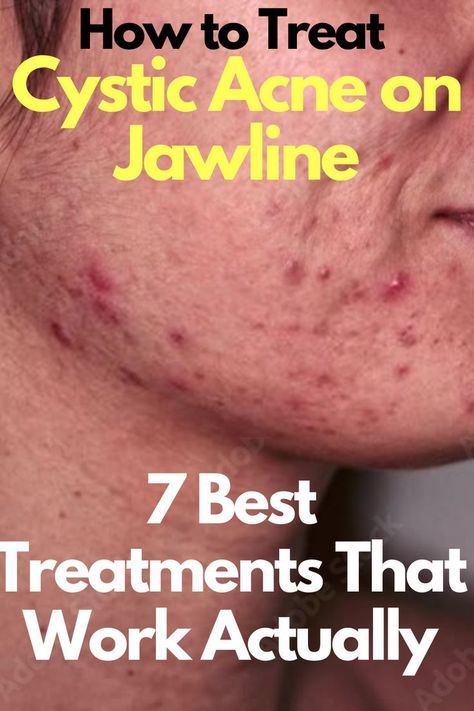 Cystic acne on jawline can be caused by changes in the skin such as puberty, pregnancy, hormonal changes, and so on. Cystic acne on jawline can also be caused by bacteria living in the body. #cysticacne #cysticacneonjawline #cysticacneonjawlinecauses #cysticacneonjawlineprevenion #cysticacneonjawlinereatment Acne On Jawline, Acne On Cheeks, Jawline Acne, Acne Men, Neck Acne, Treating Cystic Acne, Skin Blackheads, Cystic Pimple, Aesthetic For Me