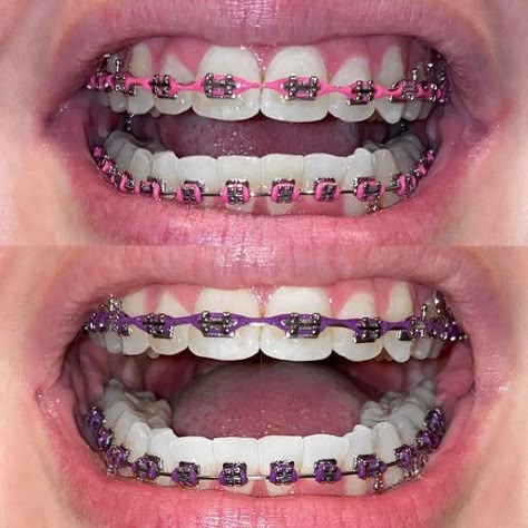 Dental Braces Colors, Braces Colors Combinations, Pink Braces, Jewelry Teeth, Green Braces, Braces Colors Ideas, Braces And Glasses, Braces Food, Teeth Tips