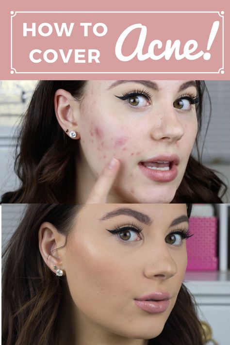 Covering Up Acne With Makeup, Makeup Hacks To Cover Acne, Best Way To Cover Acne With Makeup, Hiding Acne With Makeup, How To Conceal Acne, Make Up With Acne Skin, How To Cover Acne With Concealer, How To Cover Spots With Makeup, How To Cover Cystic Acne With Makeup